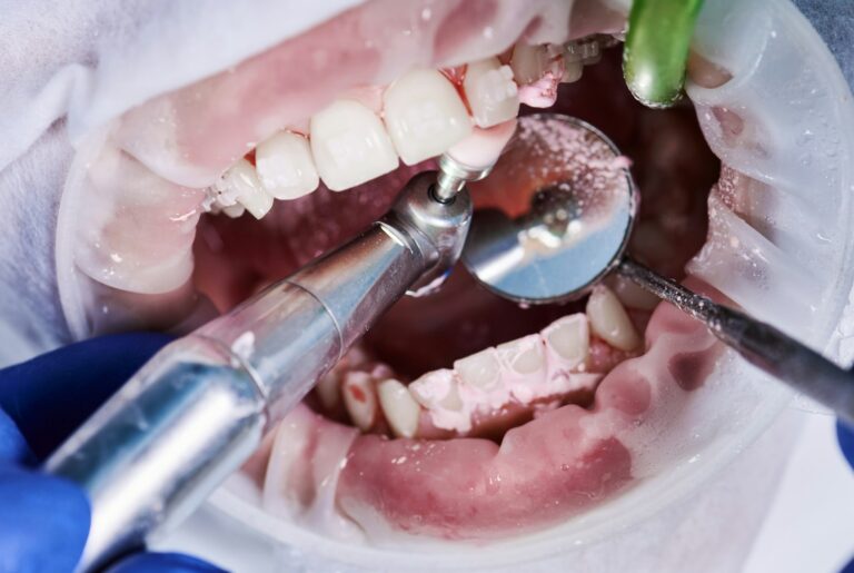 Close-up picture of a woman's mouth during dental procedure of cleaning teeth